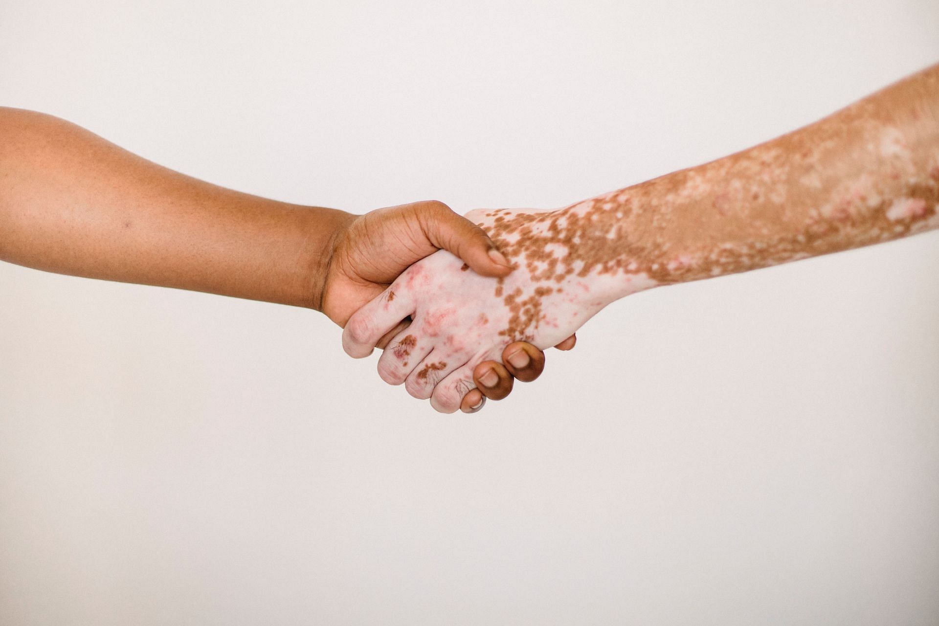 Understanding Vitiligo: Causes, Symptoms, and Treatments (Image via pexels / armin)