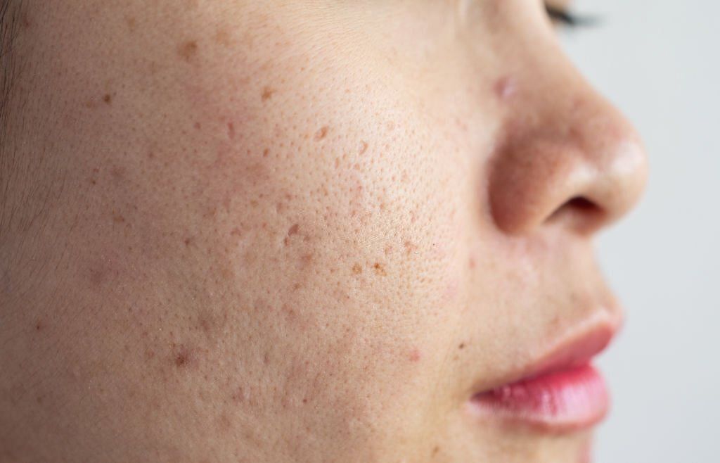 Demystifying Pore Size: Separating Fact from Fiction (Image by Getty)