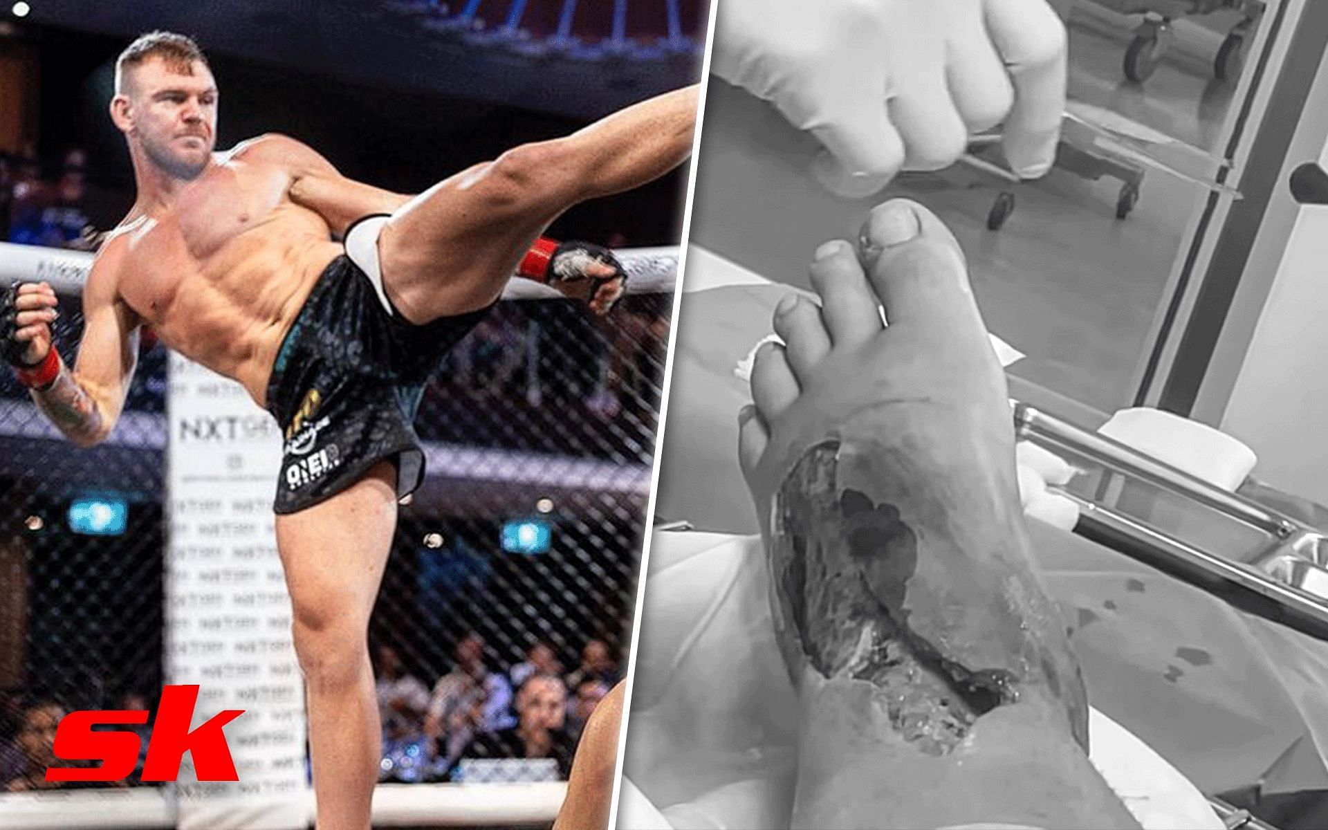 MMA fighter Tim Schultz staph infection [Images via @timbotmma on Instagram]