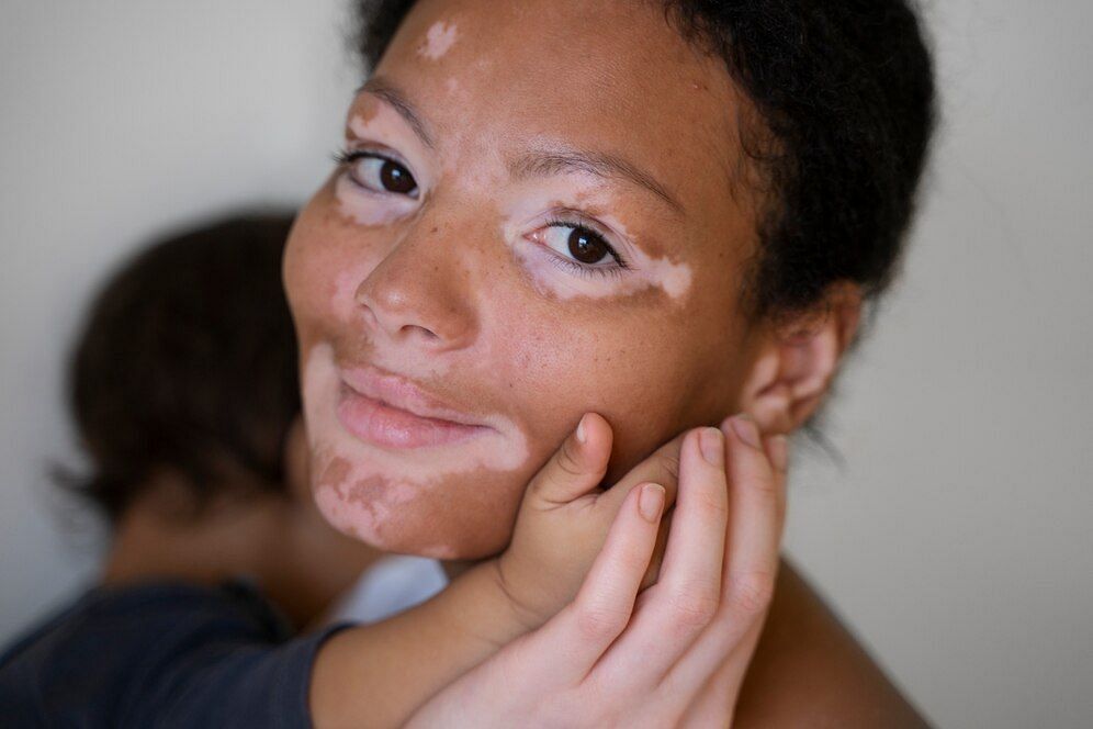 what causes Depigmentation (Image via freepik)