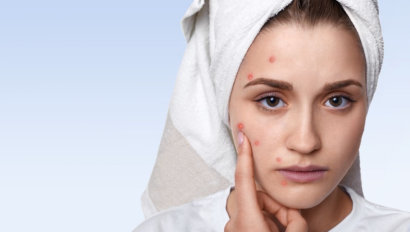 What is the difference between hormonal and bacterial acne? (Image via Freepik)