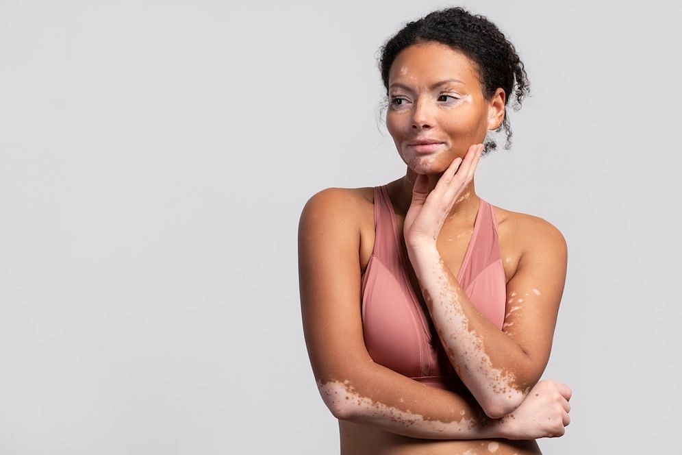 What leads to discoloured skin? (Image via Freepik)