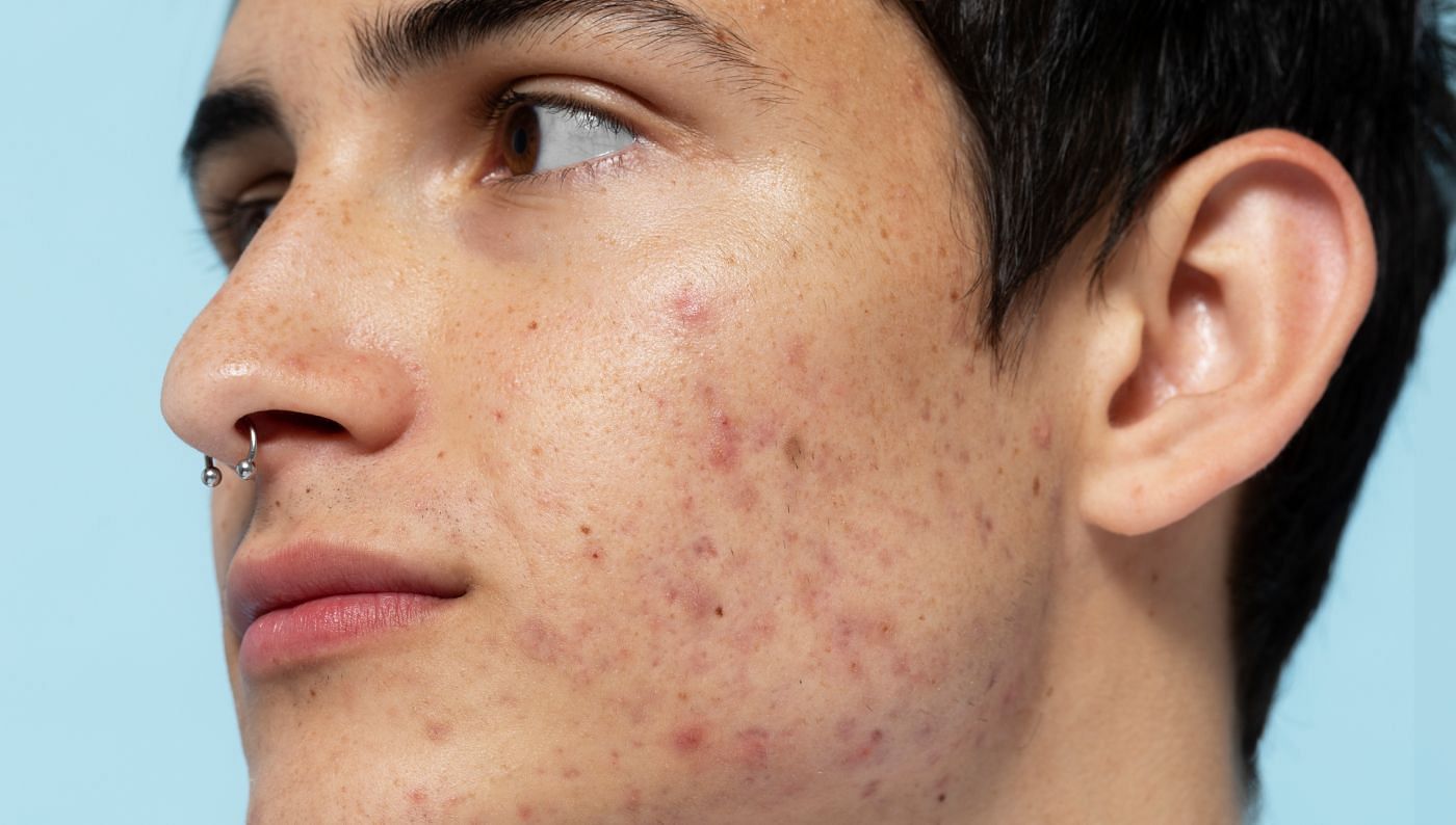 The difference between hormonal and bacterial acne (Image via Freepik)