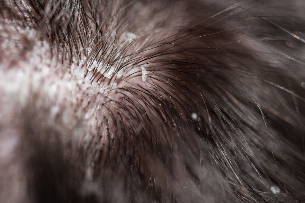 What is dandruff and what is role of diet in controlling it? (Image via iStockPhoto)