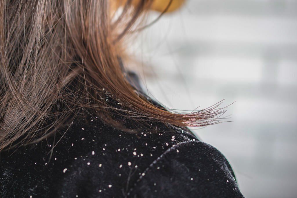 Myths and facts about dandruff (Image via iStockPhoto)