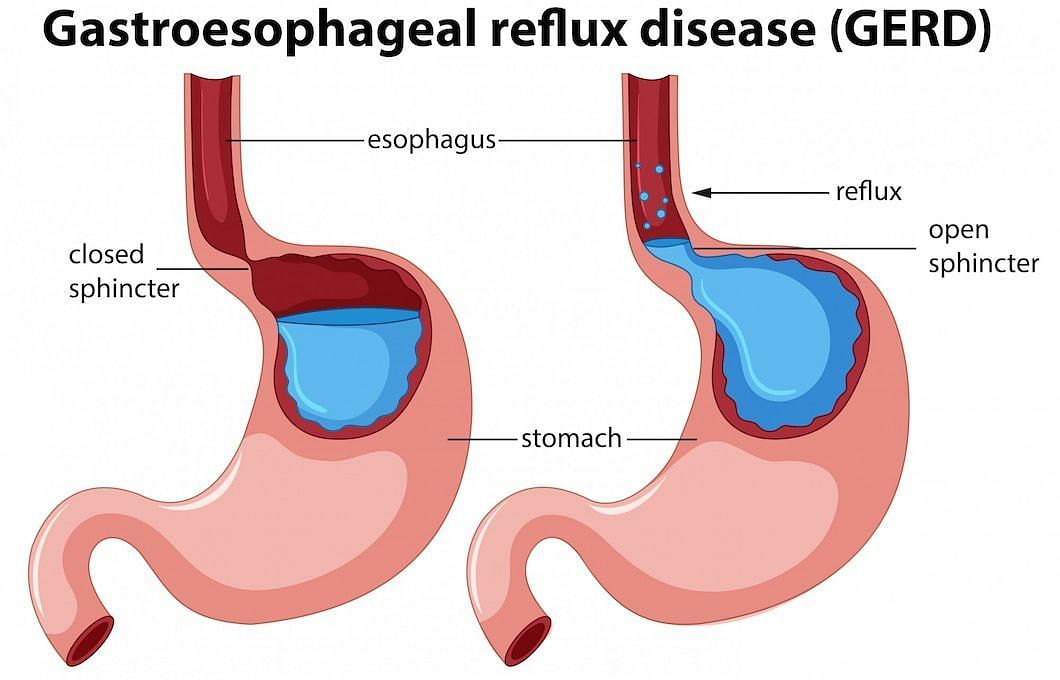 What is heartburn? (Image via Freepik/Brgfx)