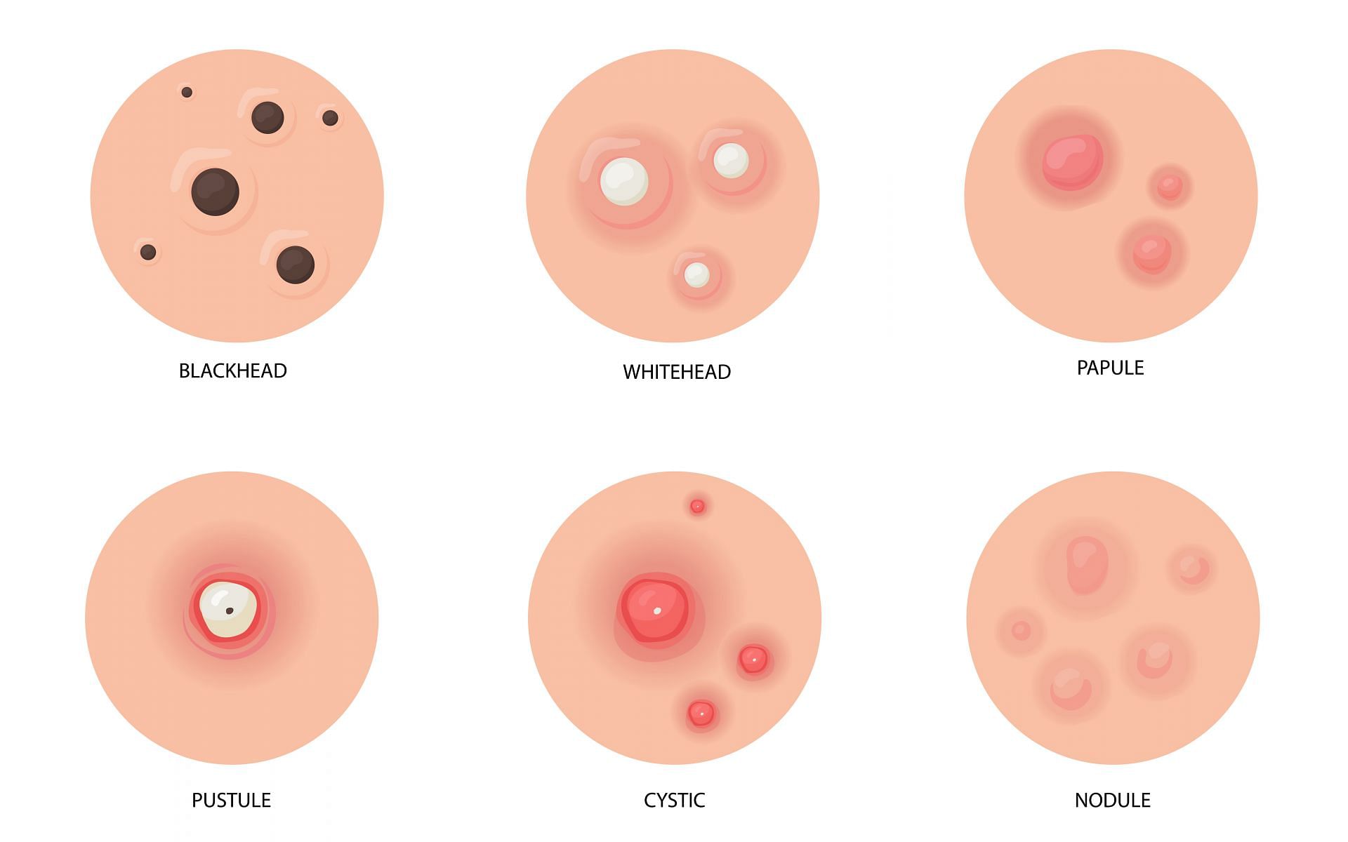 Main difference between blackheads and whiteheads (Image by pch.vector on Freepik)