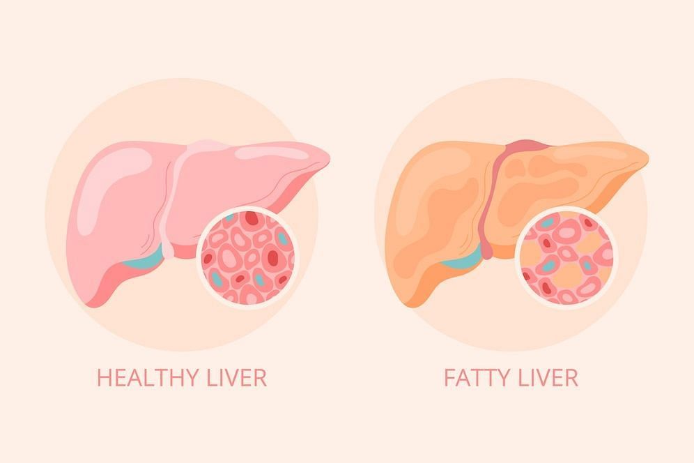 What is a fatty liver? (Image via fFeepik)