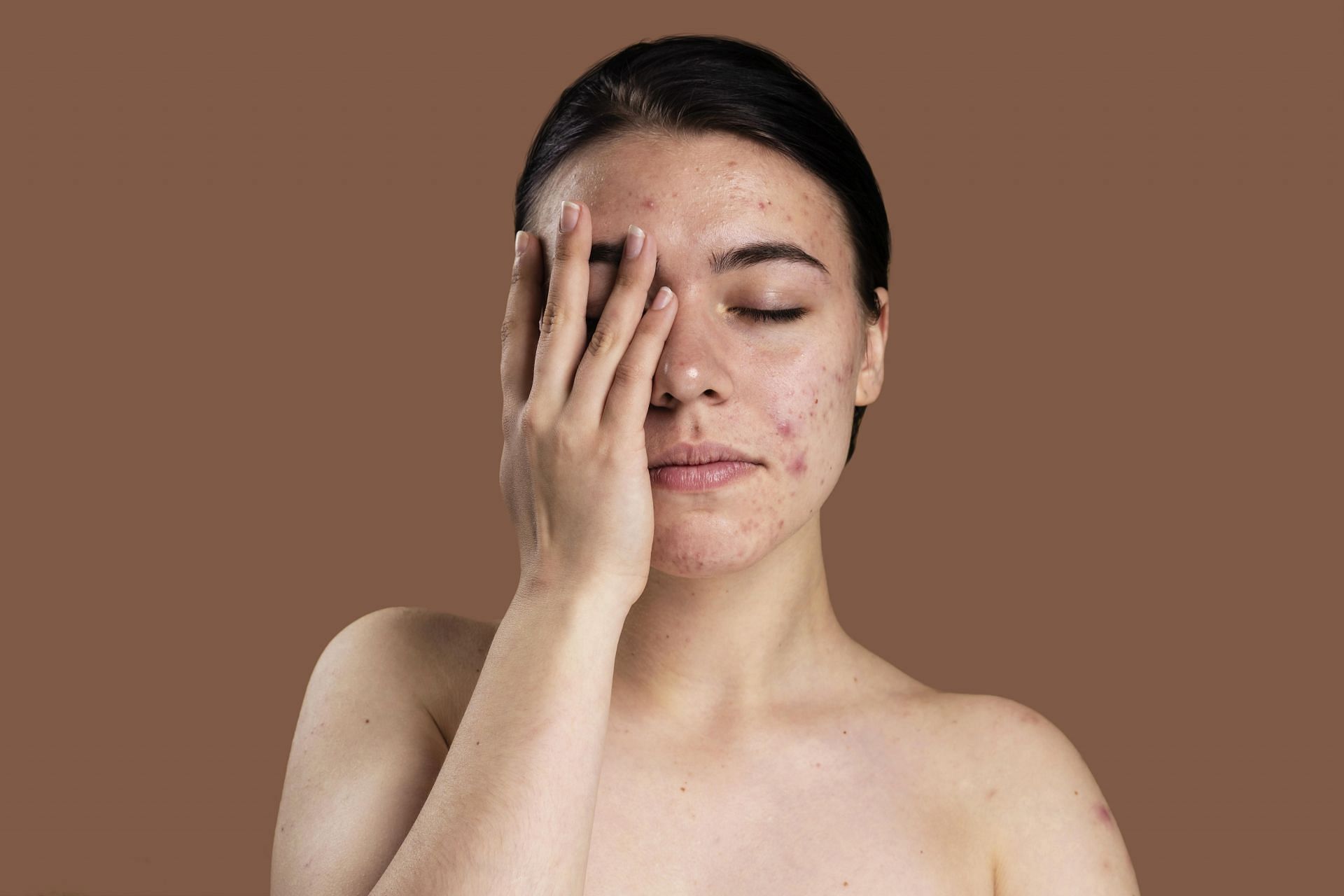 Ingredients for fighting acne and reducing inflammation (Image via Freepik)
