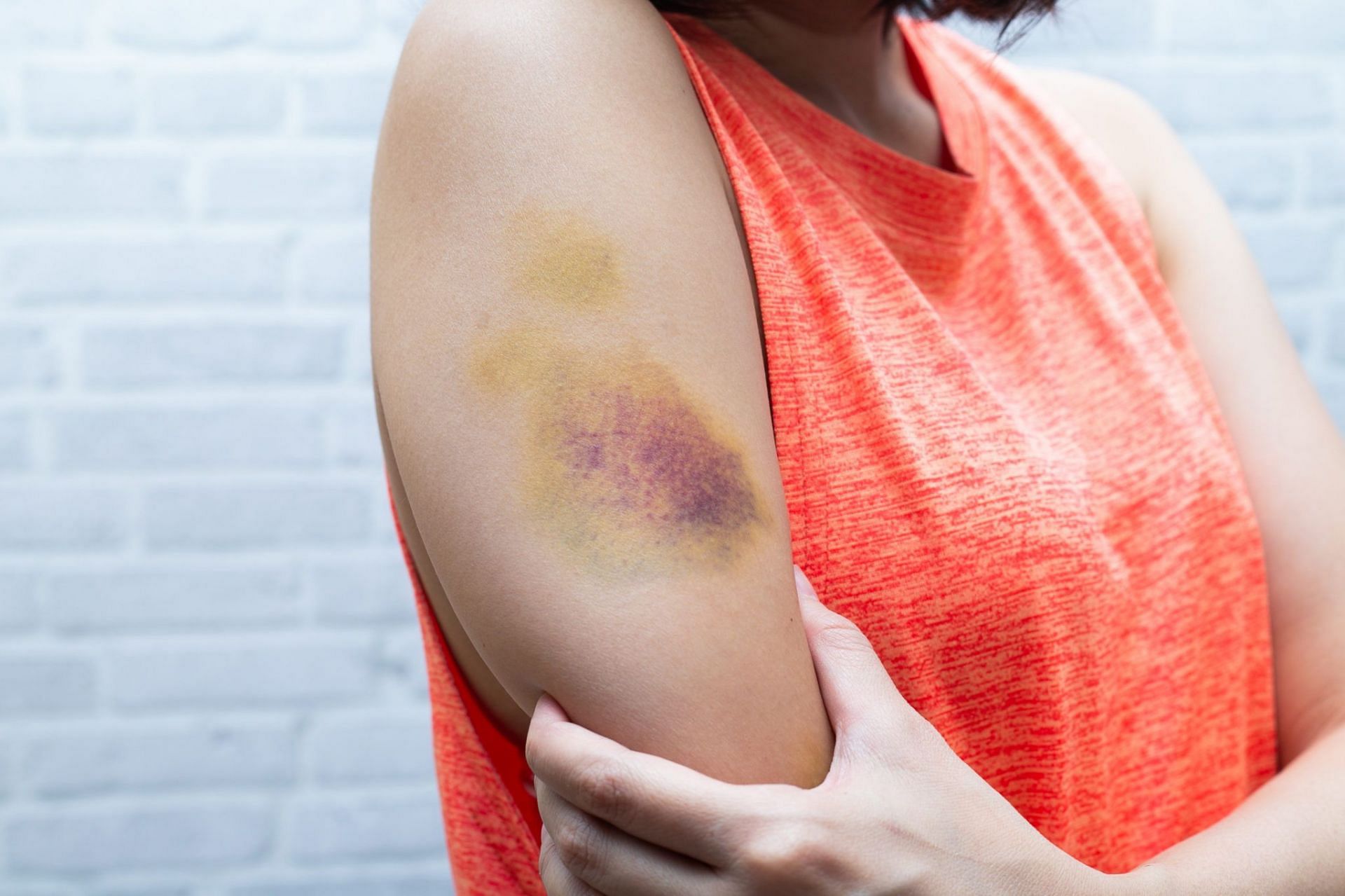 The development of yellow bruises during the initial stages can be attributed to the breakdown of hemoglobin. (Image via Shutterstock)