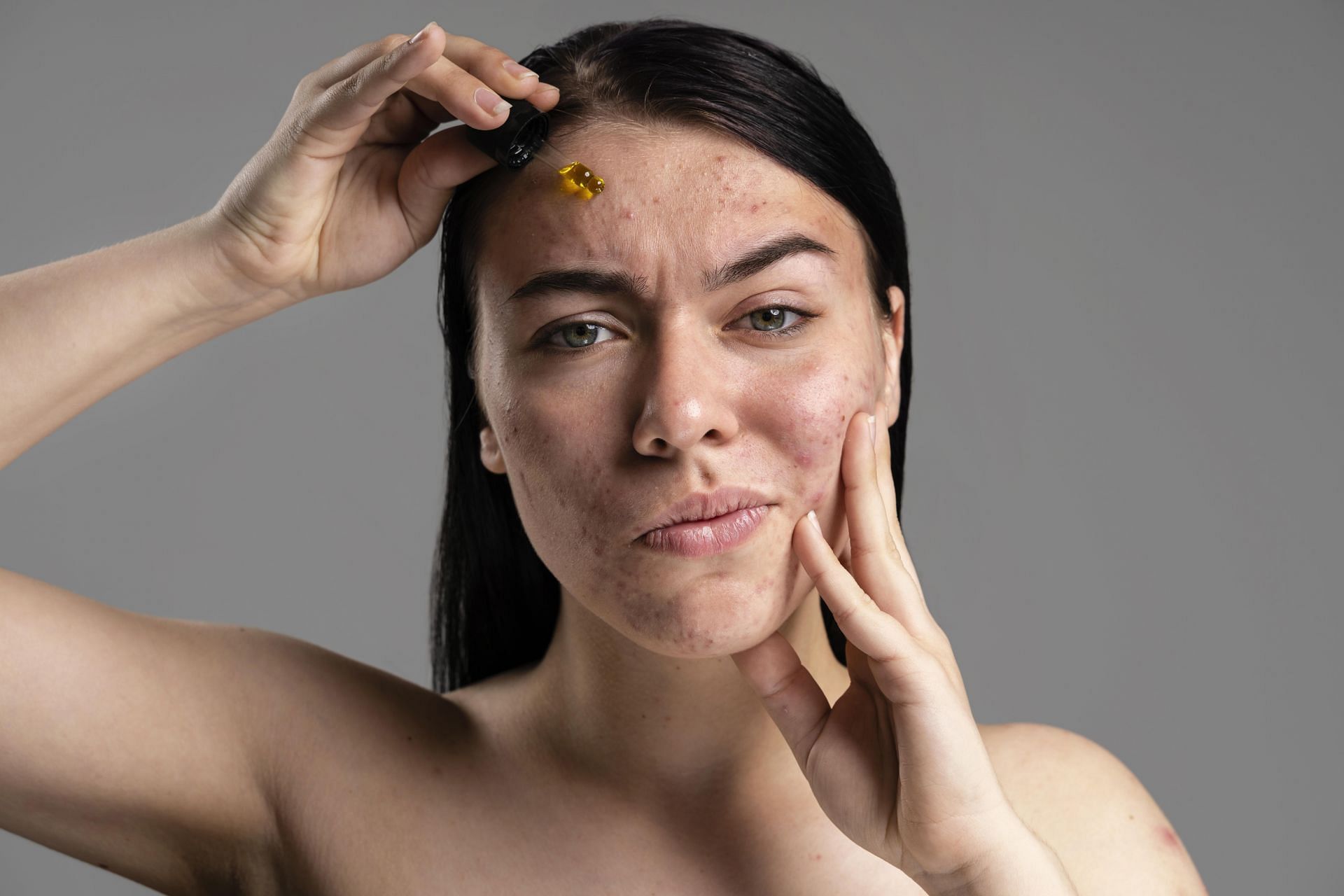 Tips for identifying and preventing acne scars (Image via Freepik)