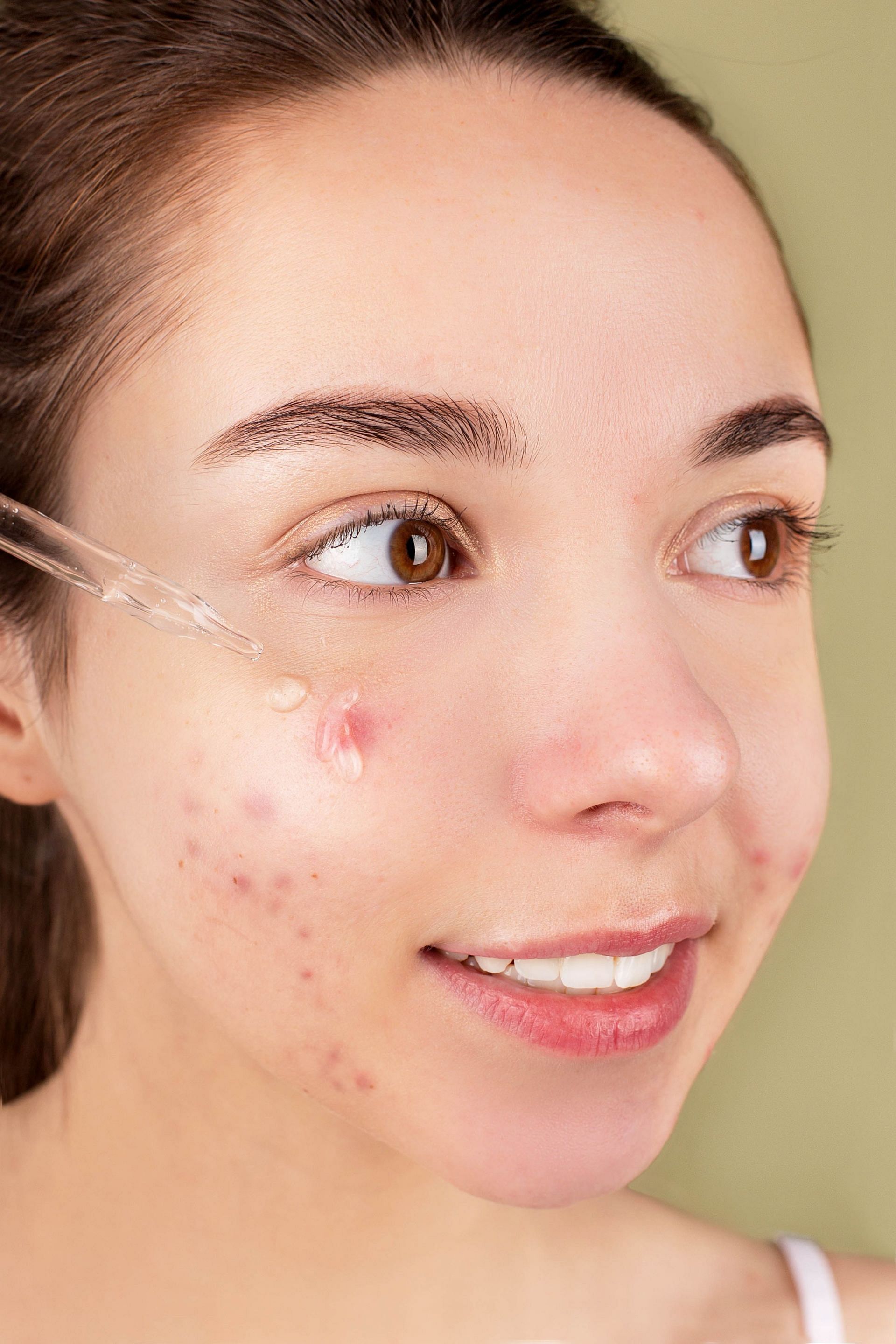 There are many ways to get rid of blackheads (image via Pexels)