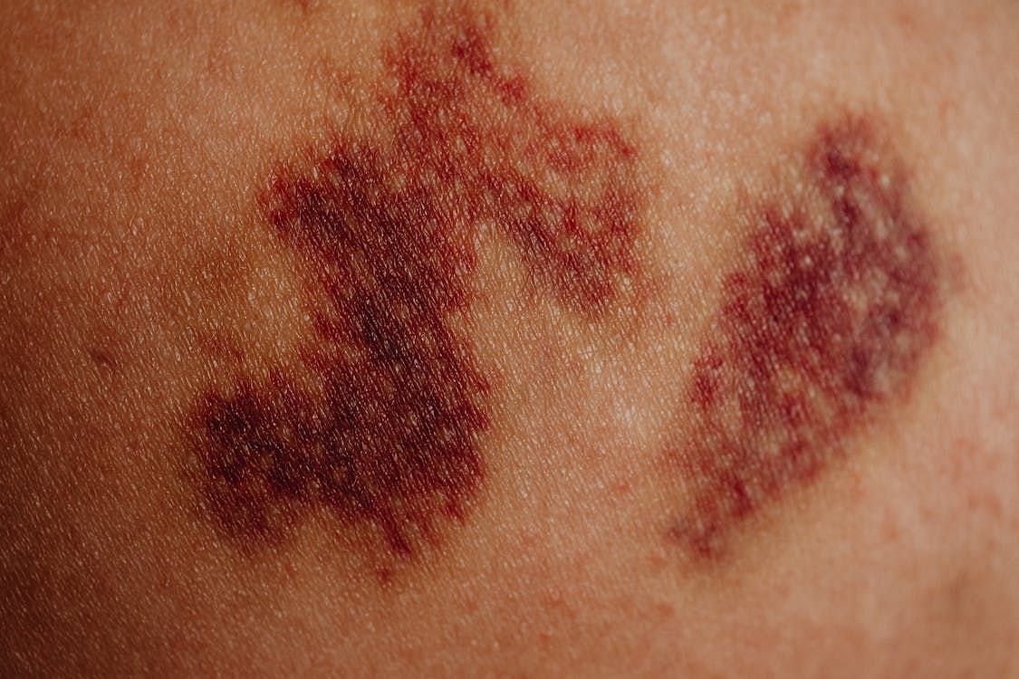 While black and blue bruises are frequently seen, yellow bruises offer a captivating insight into the intricate healing process of compromised blood vessels. (Karolina Grabowska/ Pexels)
