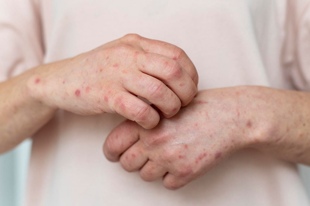 They usually appear as a red, swollen lump on the skin. (Image via Freepik)