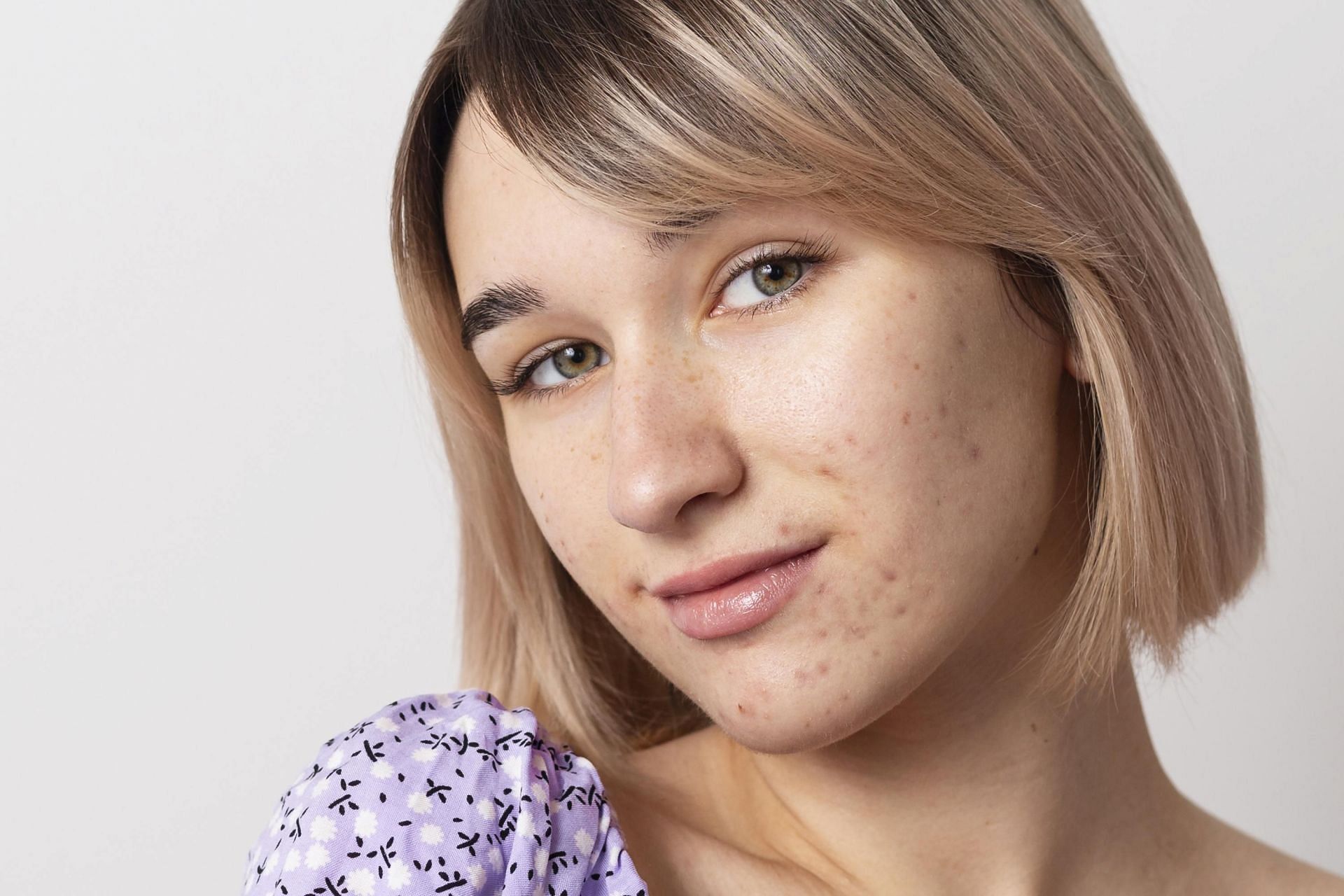 Hormonal and bacterial acne are two different things (Image via Freepik)