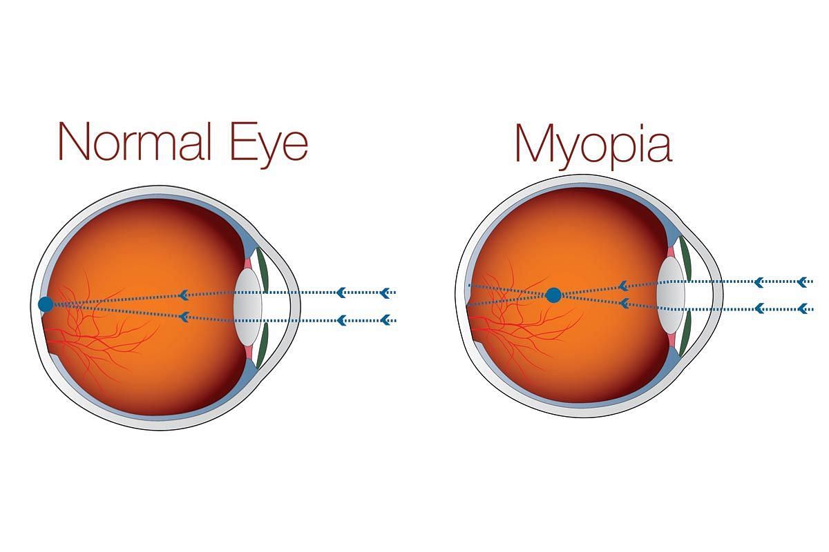 Myopia Control: Managing Nearsightedness for Healthy Vision (Image via New Vision Clinics)
