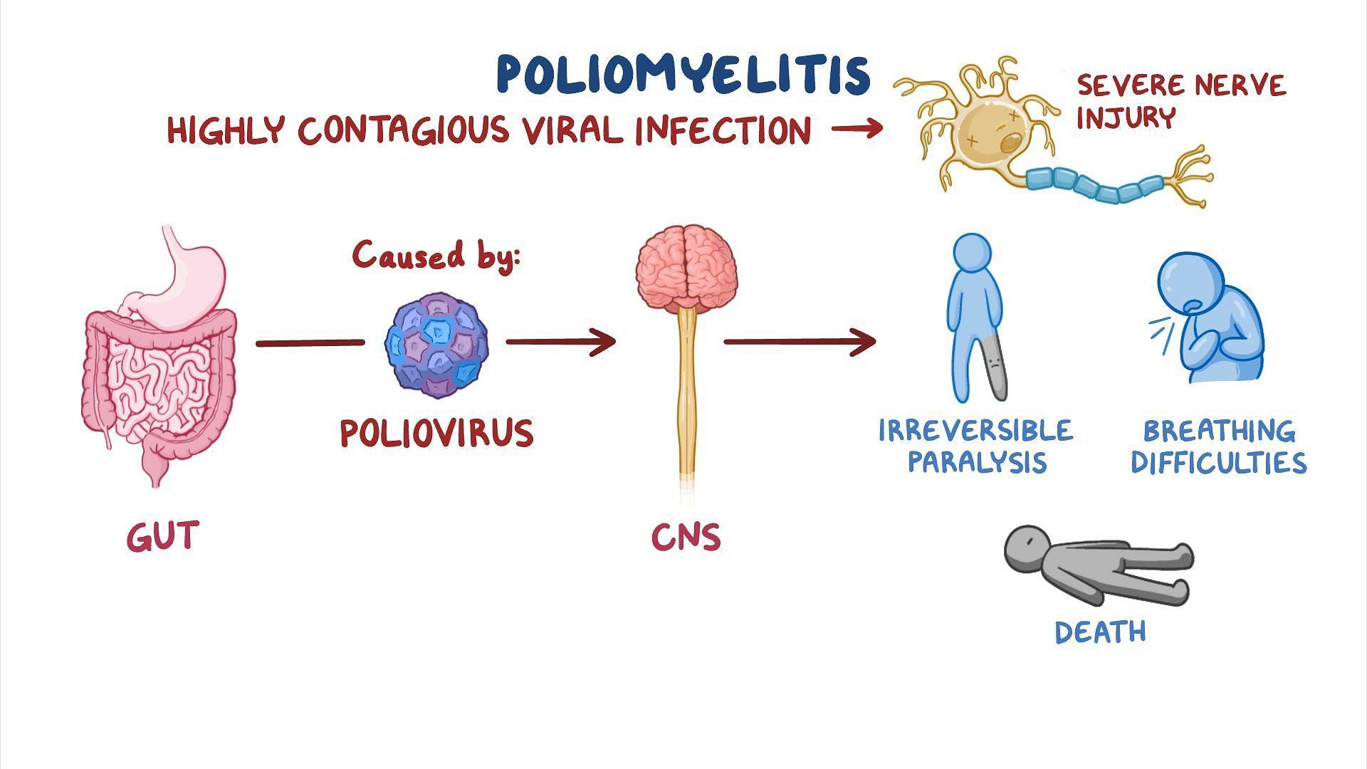 Save your kids from poliomyelitis(Image source/osmosis)