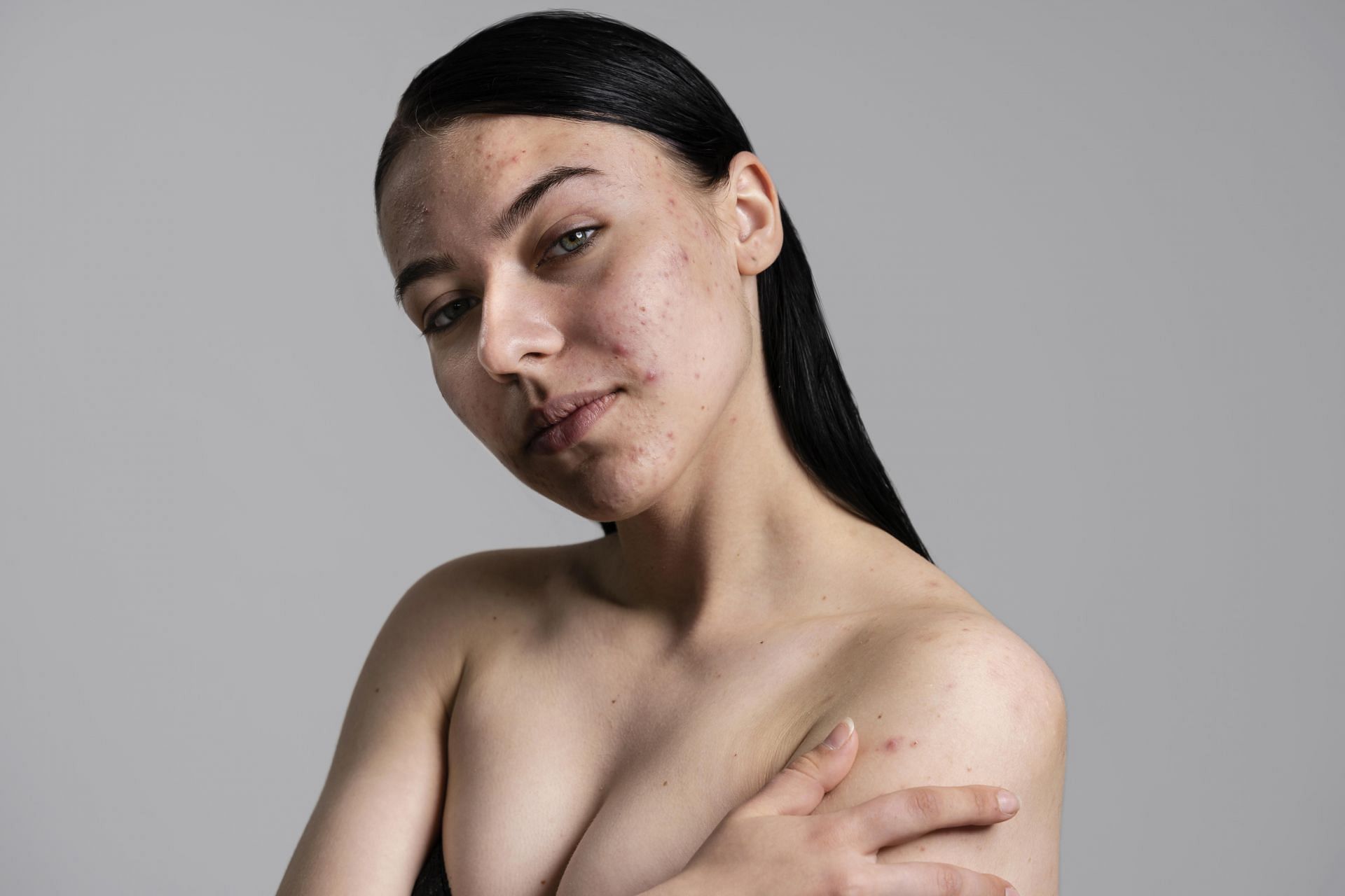 How to identify and treat acne scars? (Image via Freepik)