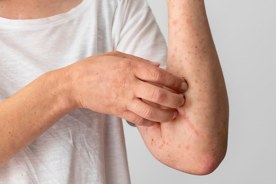 Carbuncles are painful skin infections caused by bacteria. (Image via Freepik)