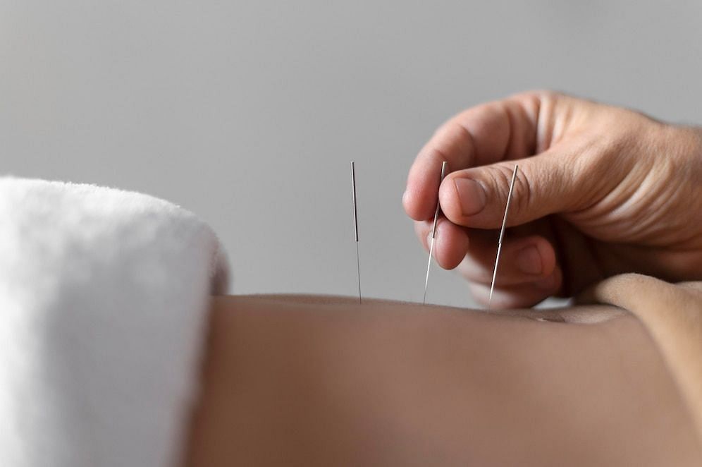what is weight loss acupuncture (image via freepik)