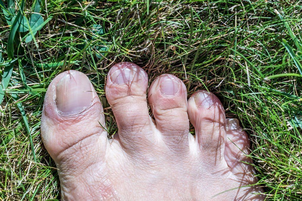 Grounding by going barefoot on grass