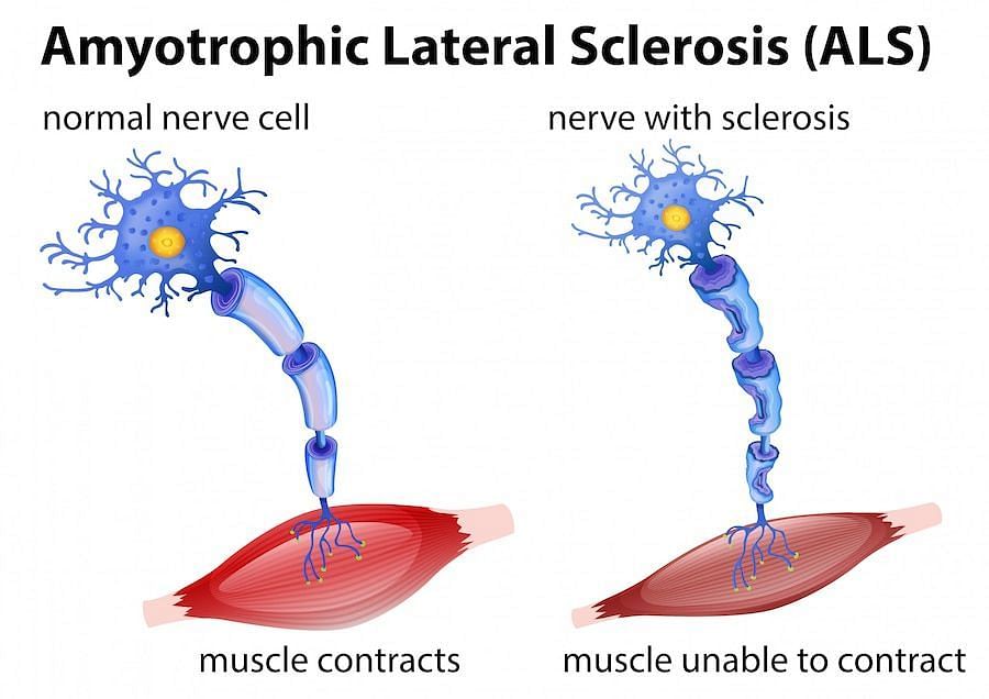 Causes of ALS (Image via Freepik/brgfx)