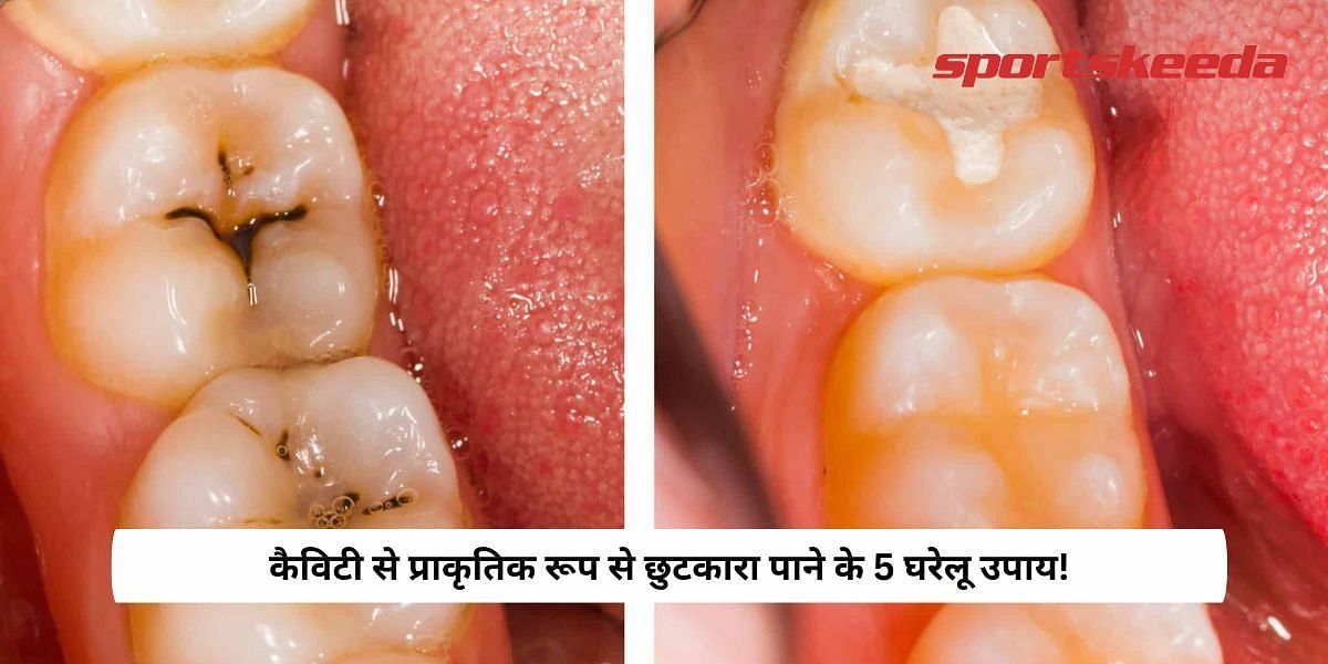 5 Home Remedies To Get Rid Of cavity Naturally!