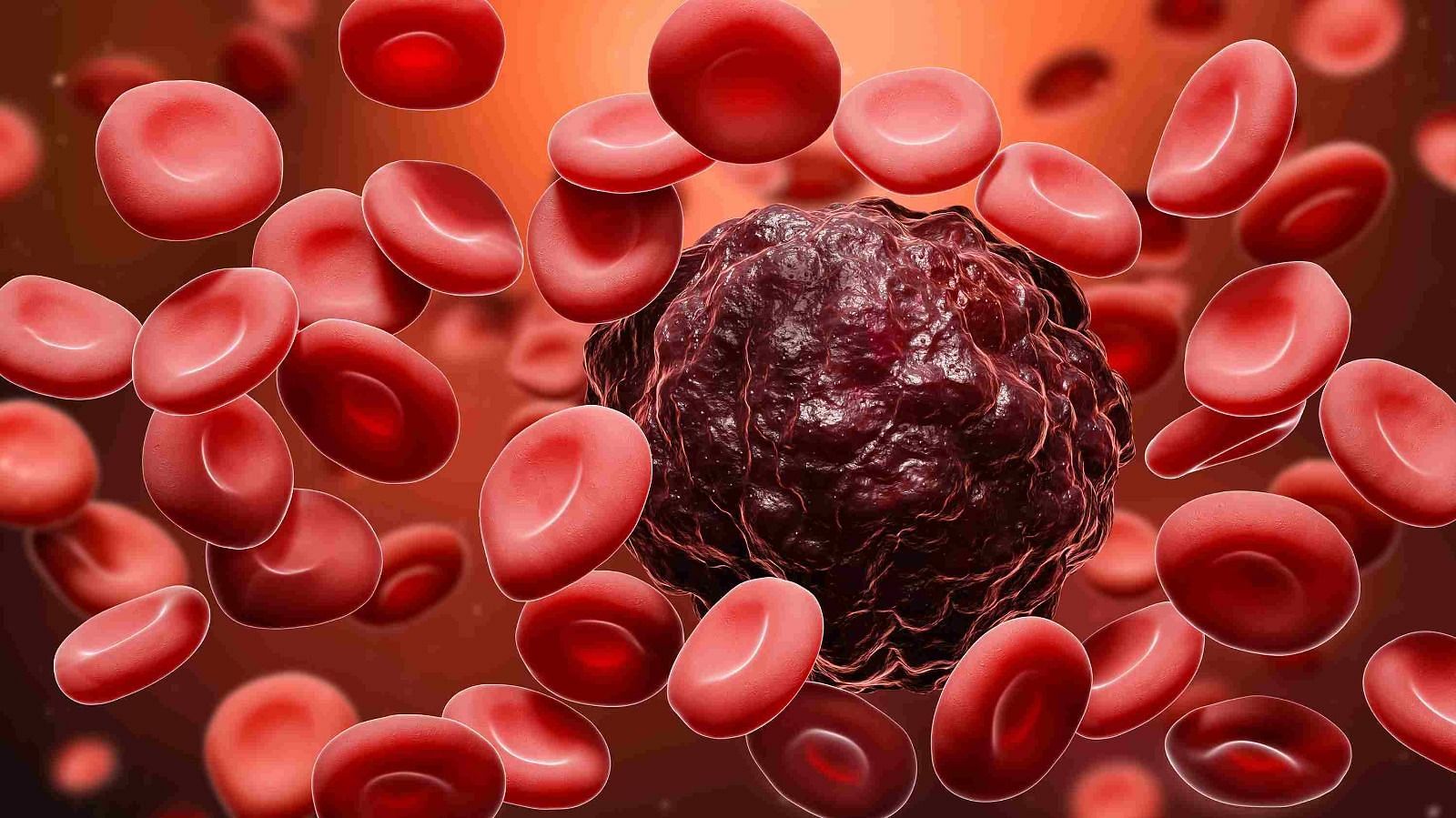 Blood Malignancy Cell (Image Via Getty)
