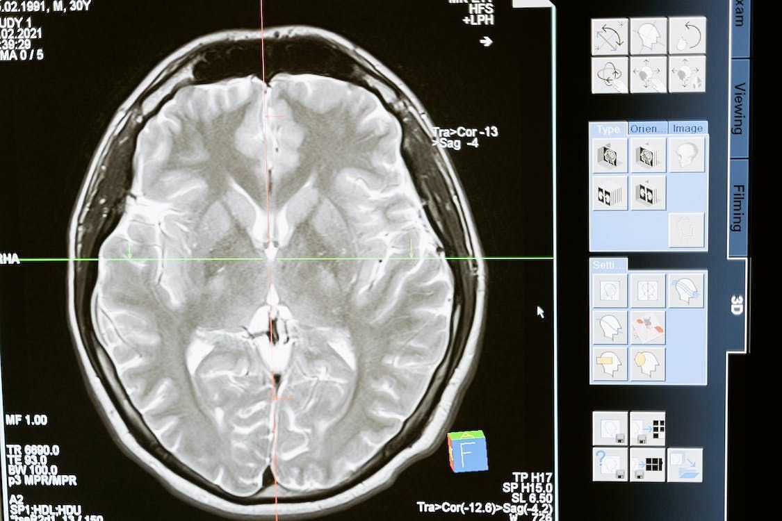 A Pressing Concern with Potentially Life-Threatening Brain Abscesses (MART PRODUCTION/ Pexels)