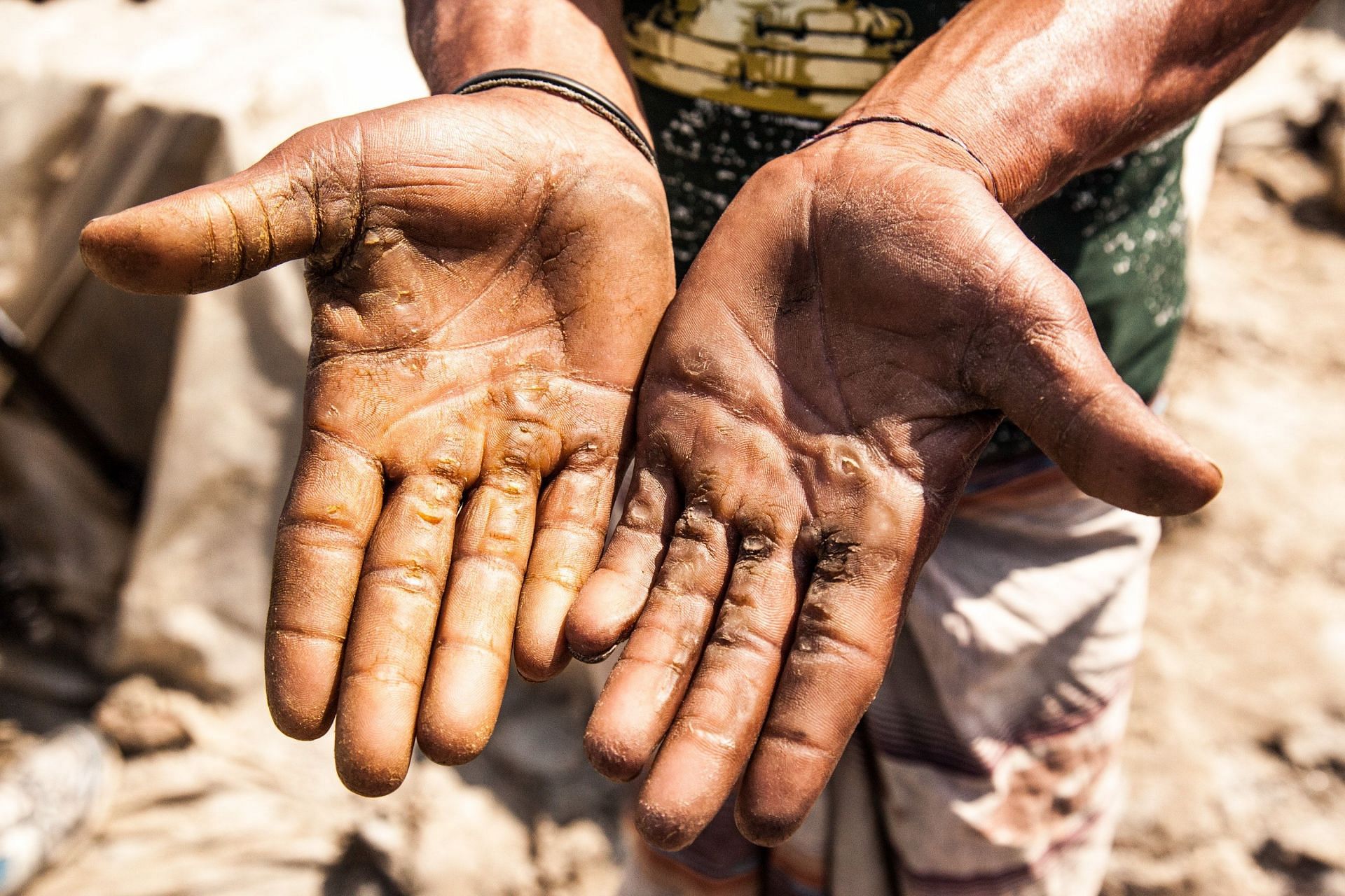 Calluses can form anywhere on the hands, elbows, knees or foot. (Image via Pexels/M Mahbub A Alahi)