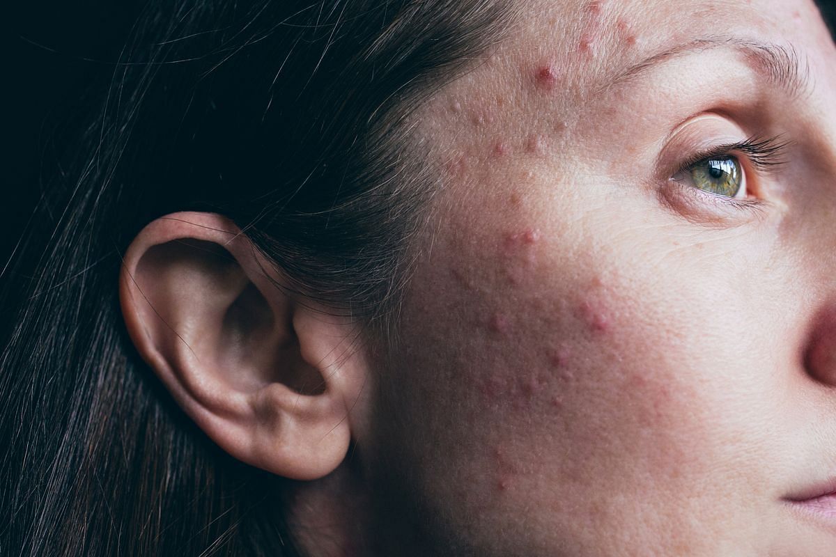 People who have acne-prone or congested skin are more prone to experiencing skin purging as a result of their preexisting skin condition. (Getty Images)
