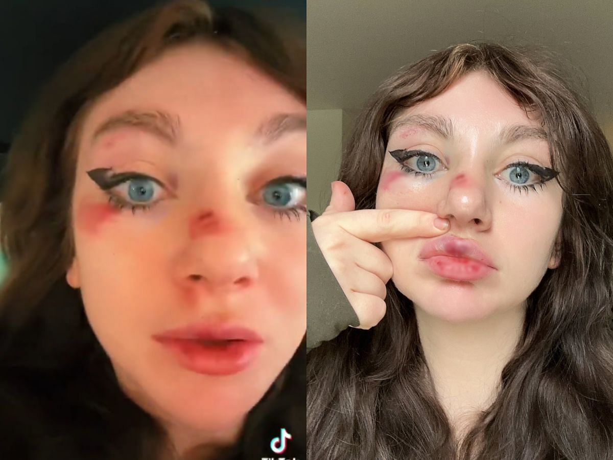 Fans concerned after JustAMinx streams with two black eyes