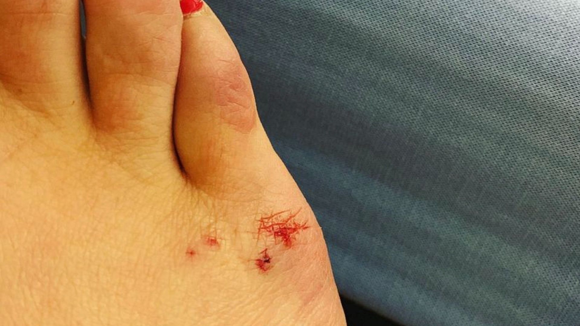 Symptoms of rat bites can include swelling, bleeding, and pain. (Photo via Instagram/libbykuts)