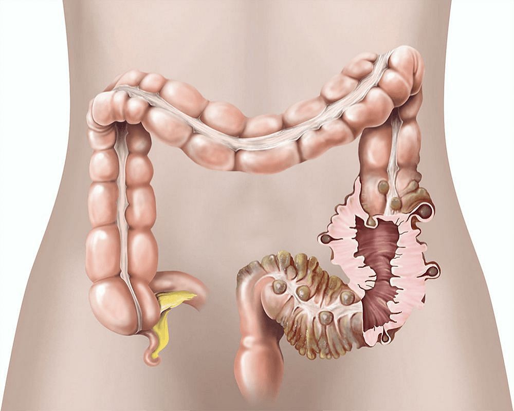 The treatment approach for diverticular is determined based on the particular condition and the severity of the symptoms. (Image via Healthdirect.com)