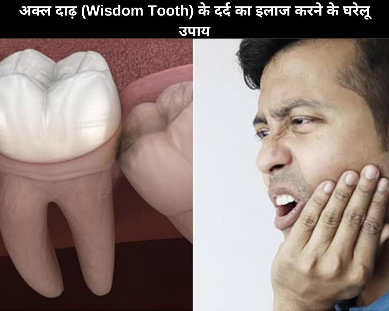 अक्ल दाढ़ (Wisdom Tooth) के दर्द का इलाज करने के 9 घरेलू उपाय (फोटो - sportskeedaहिन्दी)