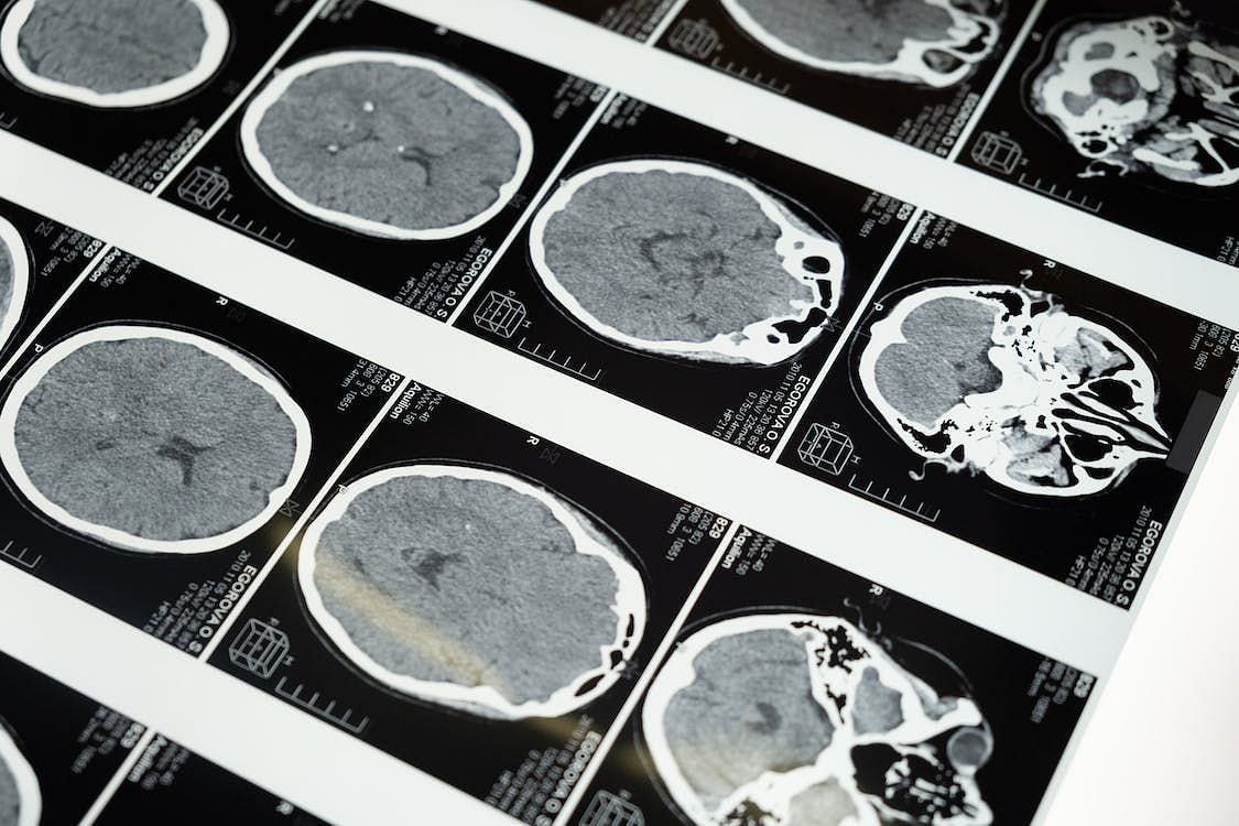 A brain abscess is an infrequent yet severe condition. (Cottonbro Studio/Pexels)