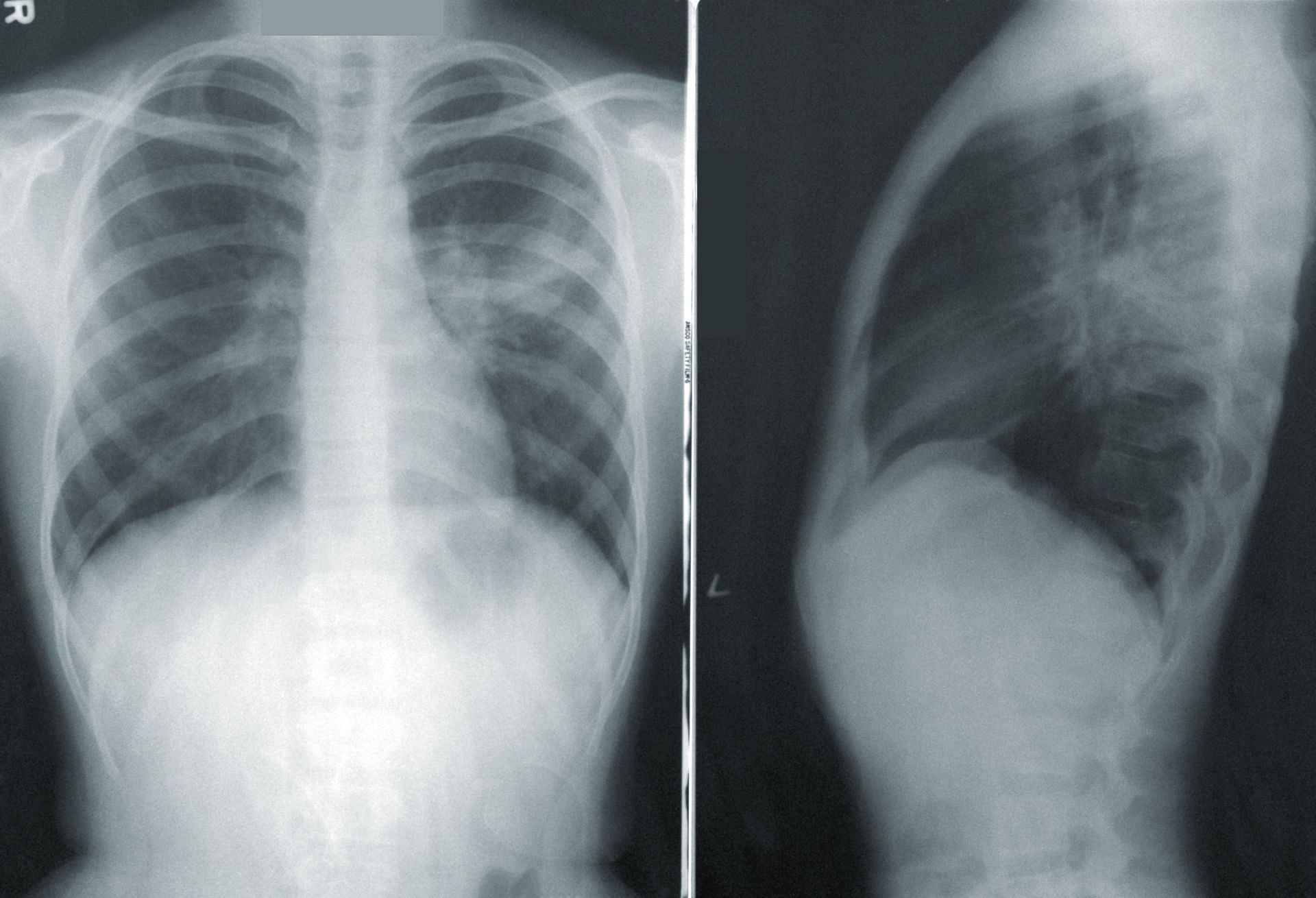 Pleuritis can be diagnosed using X-Ray and CT/MRI scans (Image via Unsplash/CDC)