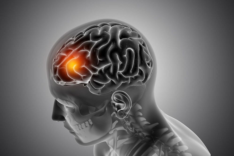 What are Brain Aneurysm Symptoms (Image via freepik)