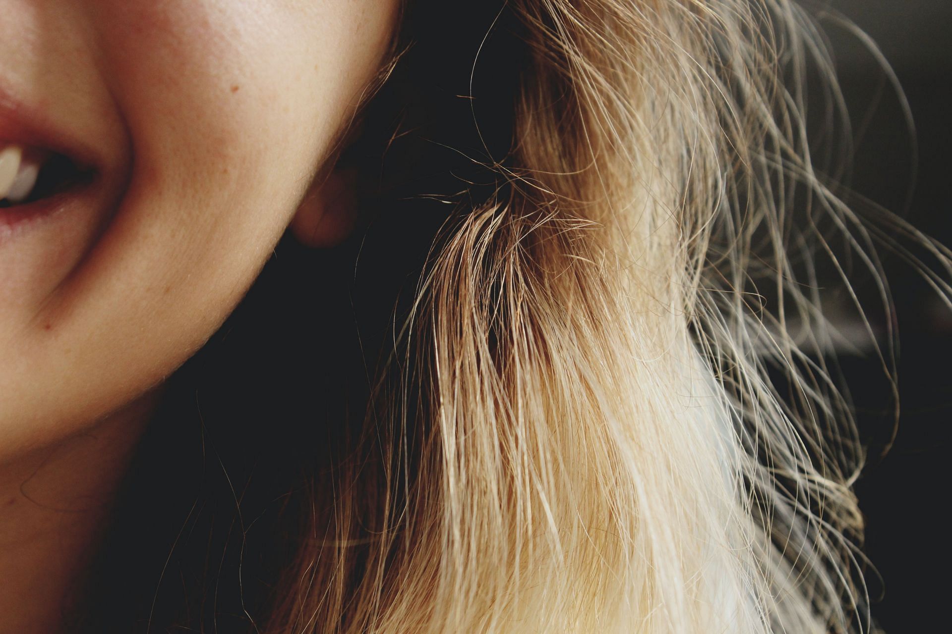 Mixed types of dandruff show symptoms of both oily and dry dandruff. (Image via Unsplash/ Brandi Redd)