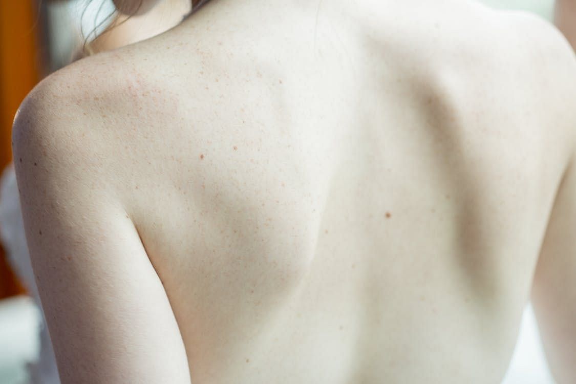 Blackheads on back can be irritating. (NEOSiAM 2021/Pexels)