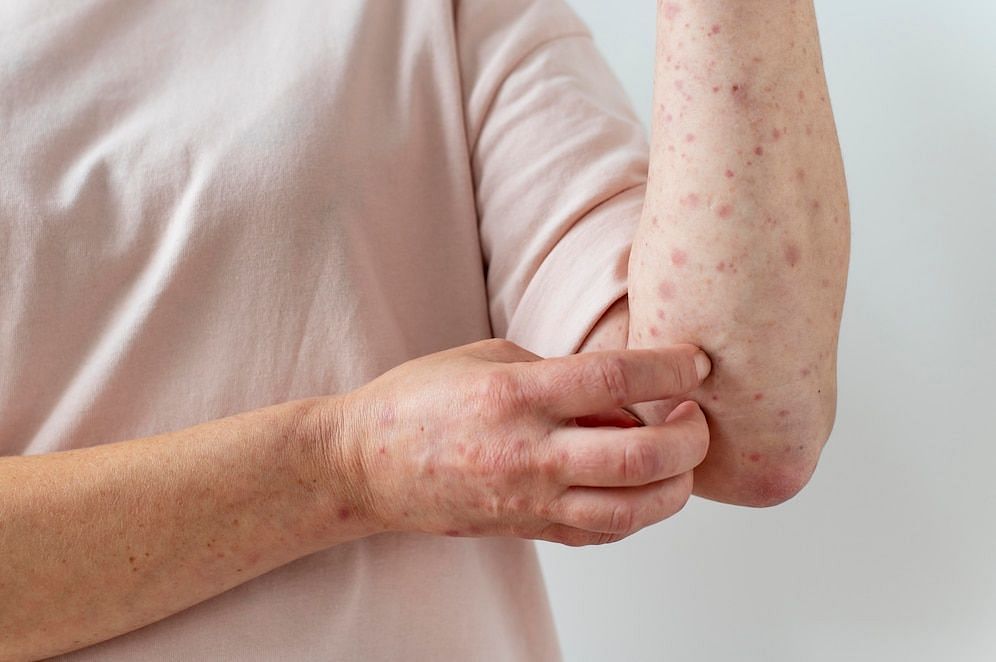 Can this rash spread? (Image via Freepik)