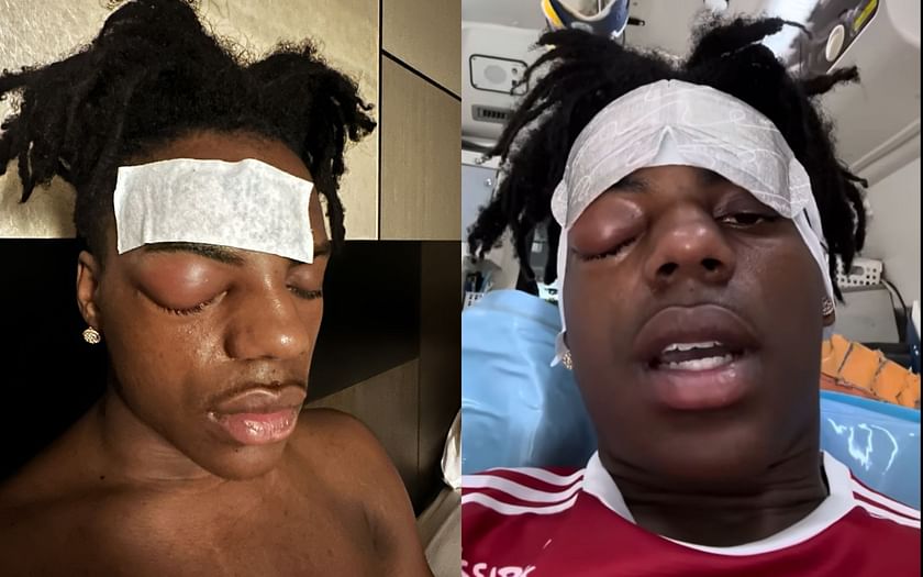 IShowSpeed Rushed To Hospital Over Headache And Swollen Eye: 'I've