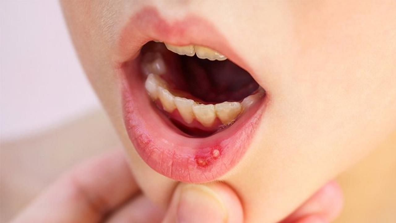 Canker-sores (Image via Getty Images)