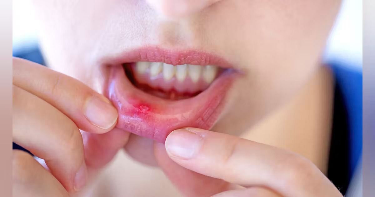 Canker-sores (Image via Getty Images)