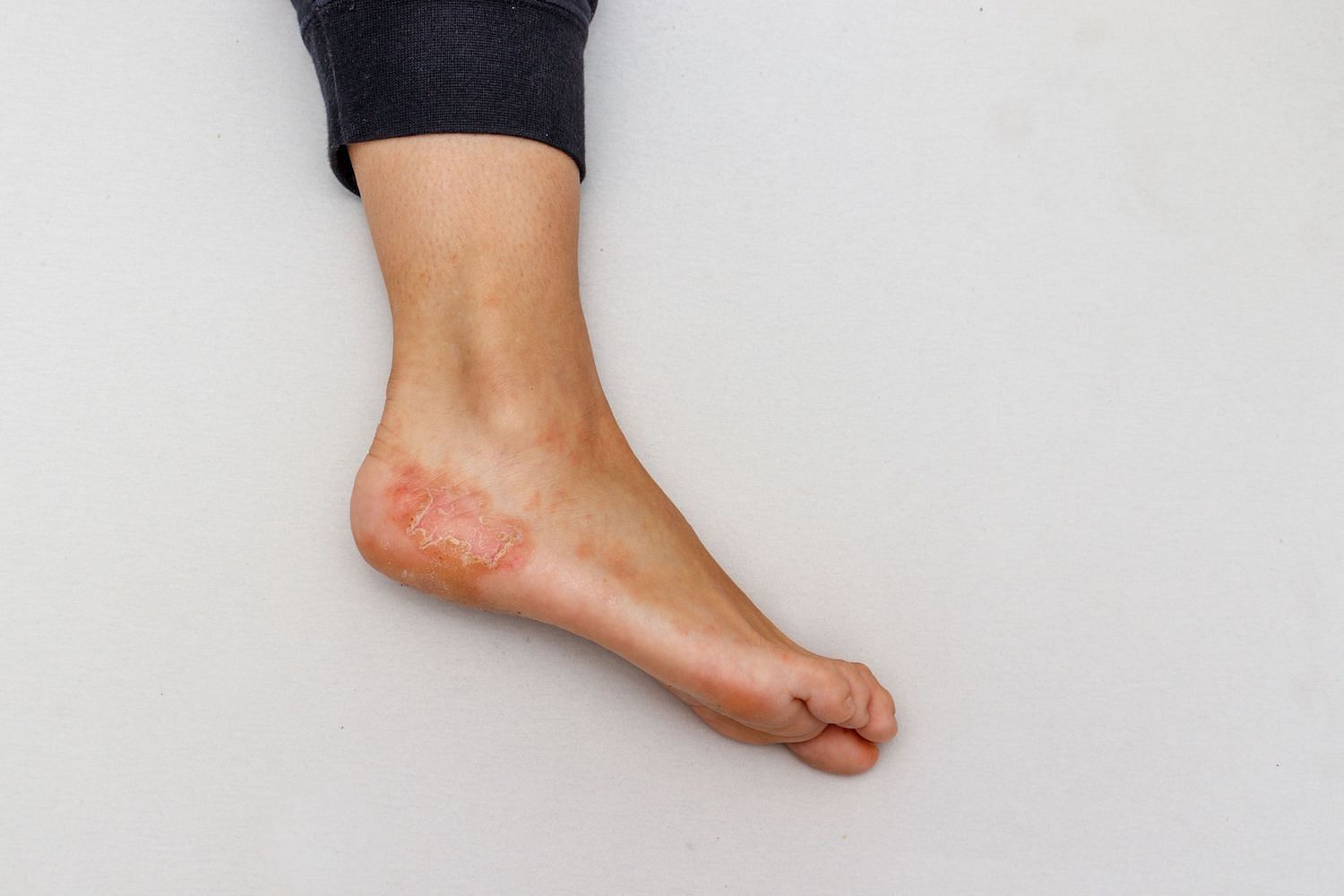 mild eczema on feet