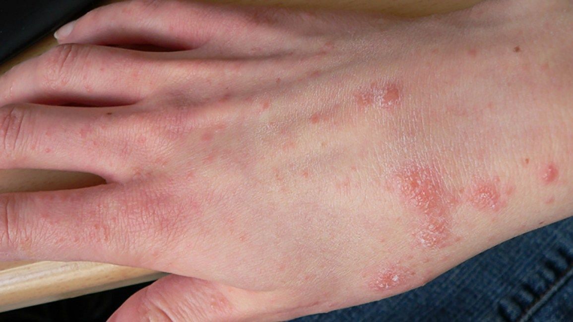 Scabies -Image via Medical News Today