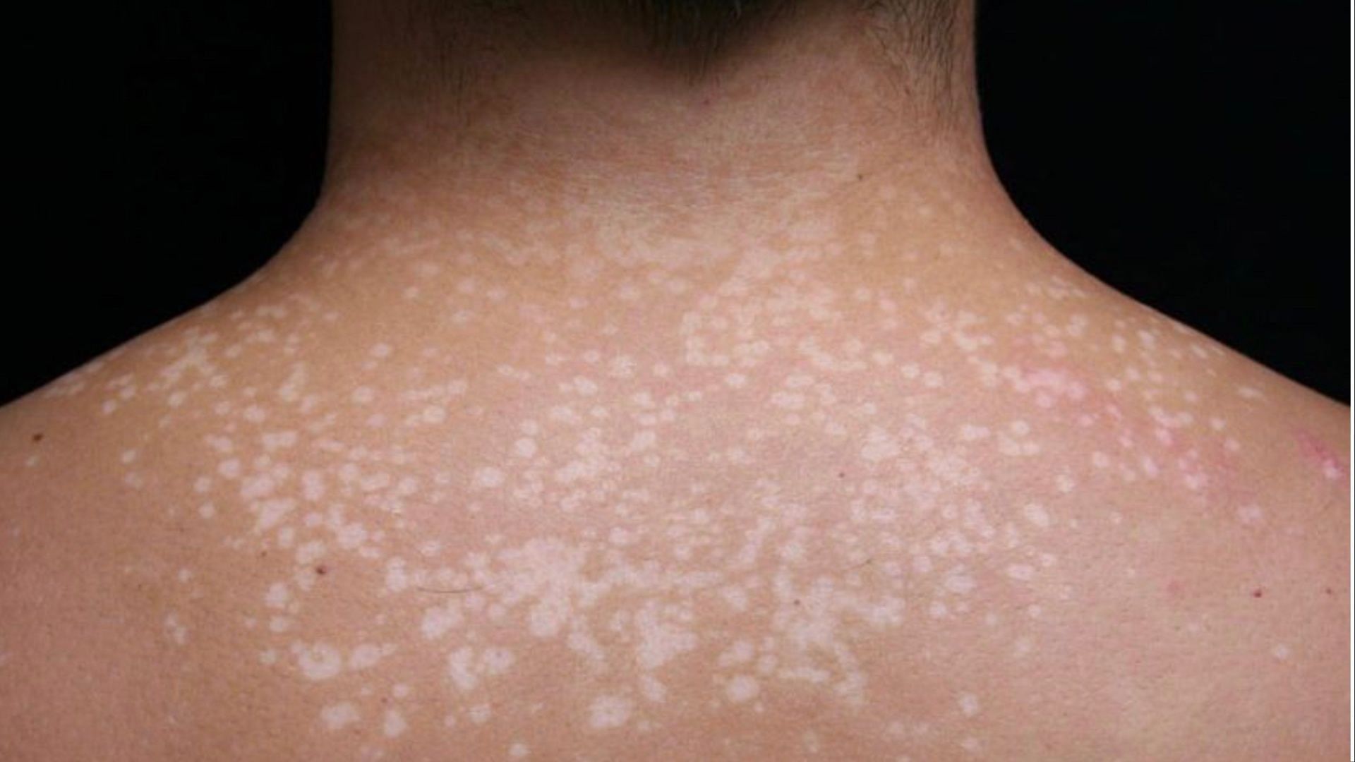 Tinea versicolor is a fungal skin infection. (Photo via Instagram/childrensskincenter)