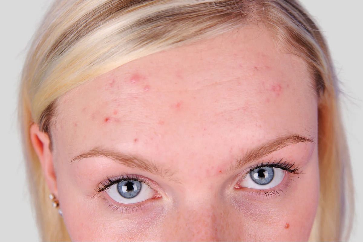 Acne on the forehead (Image via Getty Images)