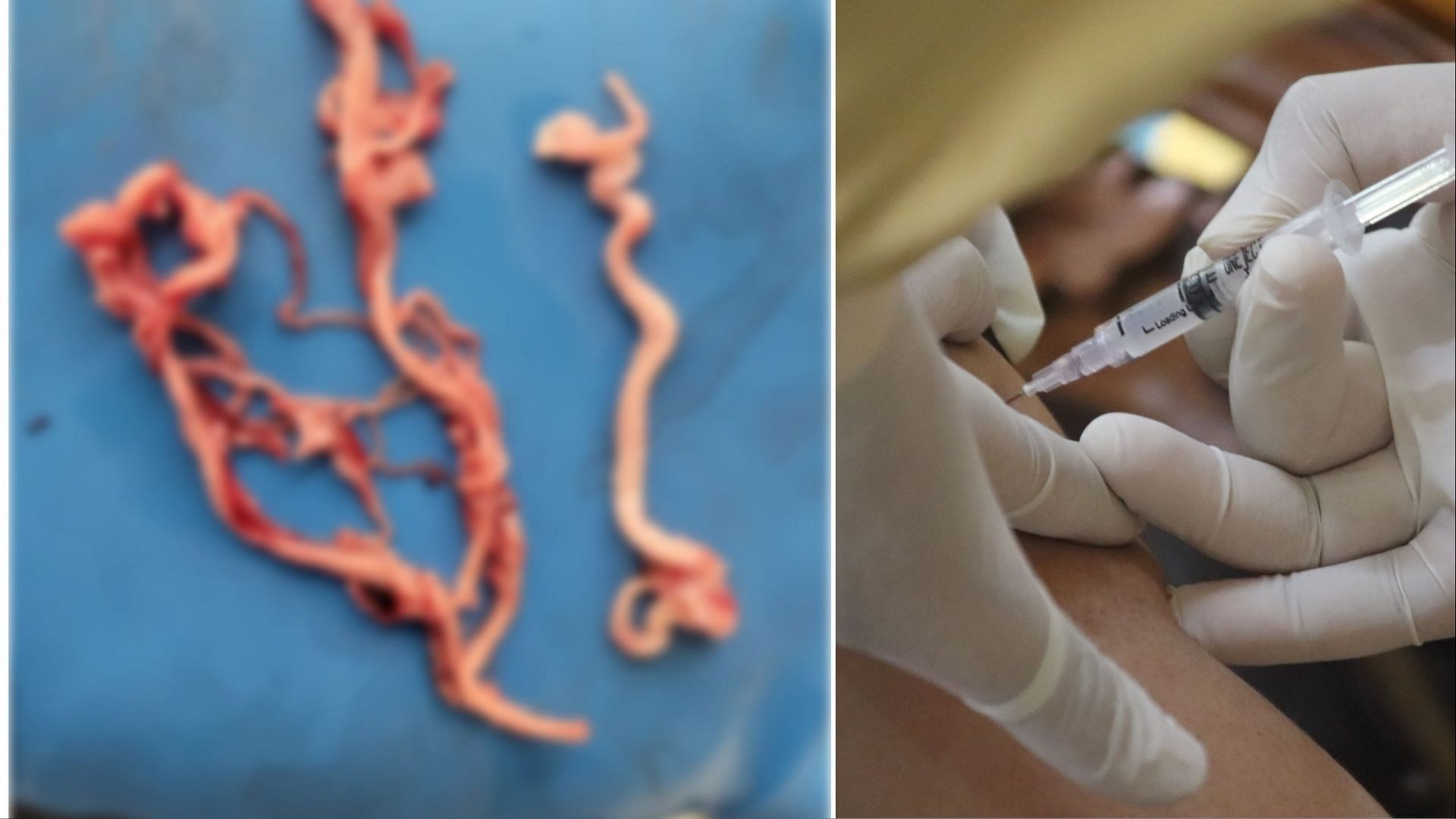 blood clots found in patients with COVID vaccines (Left Image via Twitter @RichardHirschman/ Right Image Unsplash Mufid )