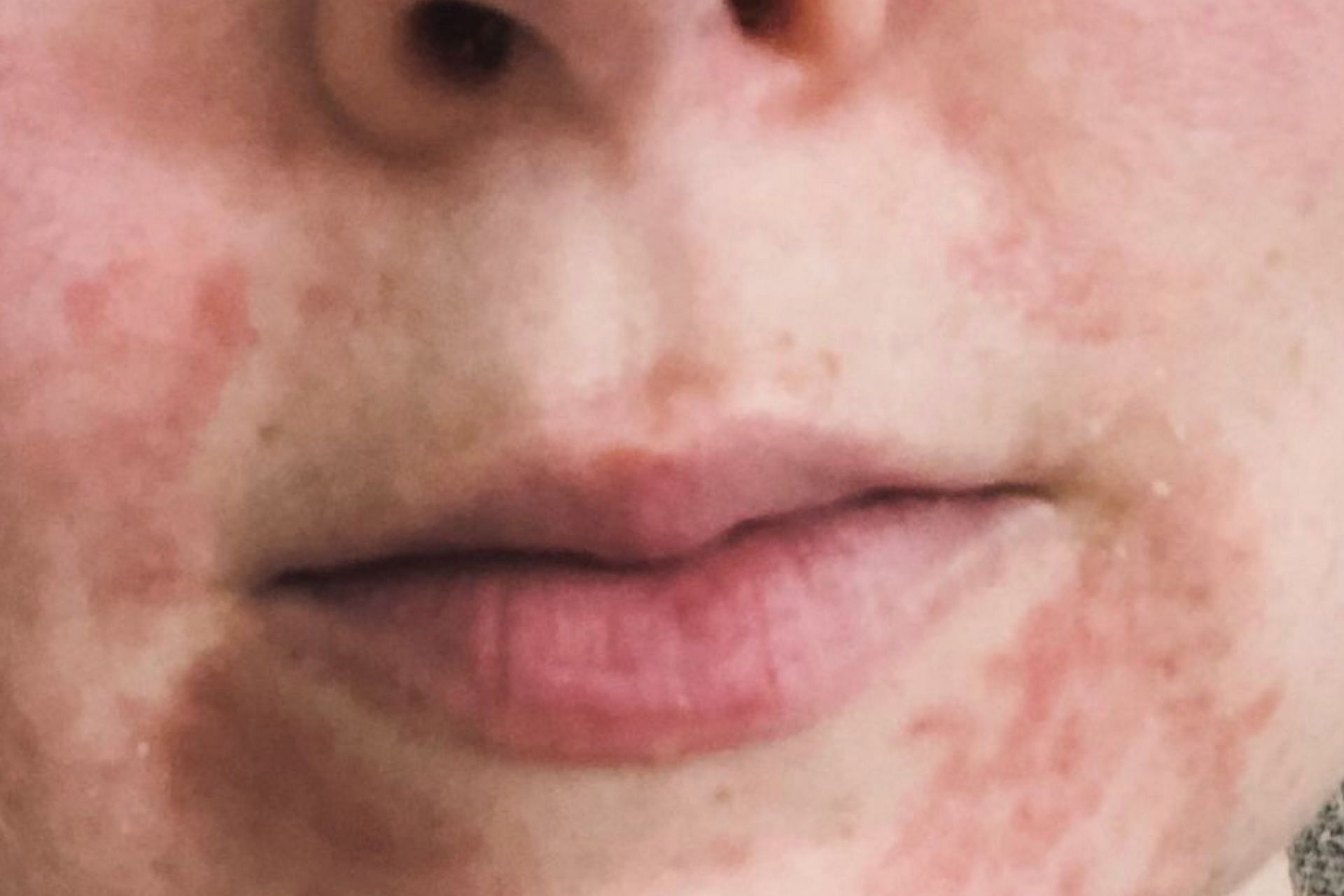 The condition appears around the mouth. (Photo via Instagram/amandascuteface)